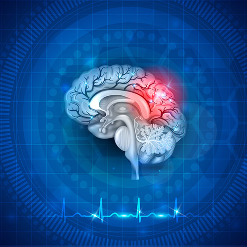 Enfermedad cerebrovascular