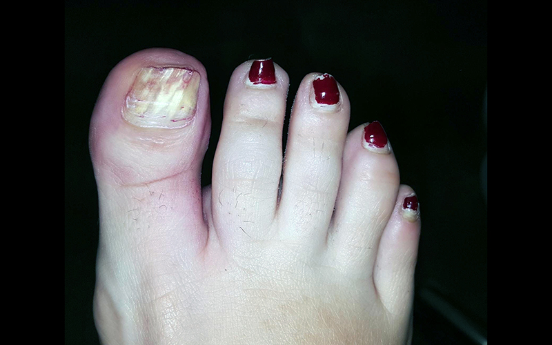 El abuso de puede dañar las uñas los pies - Rioja