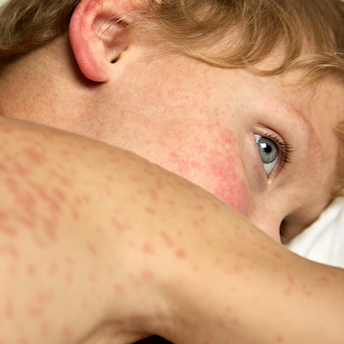 Alerta epidemiológica: Sarampión